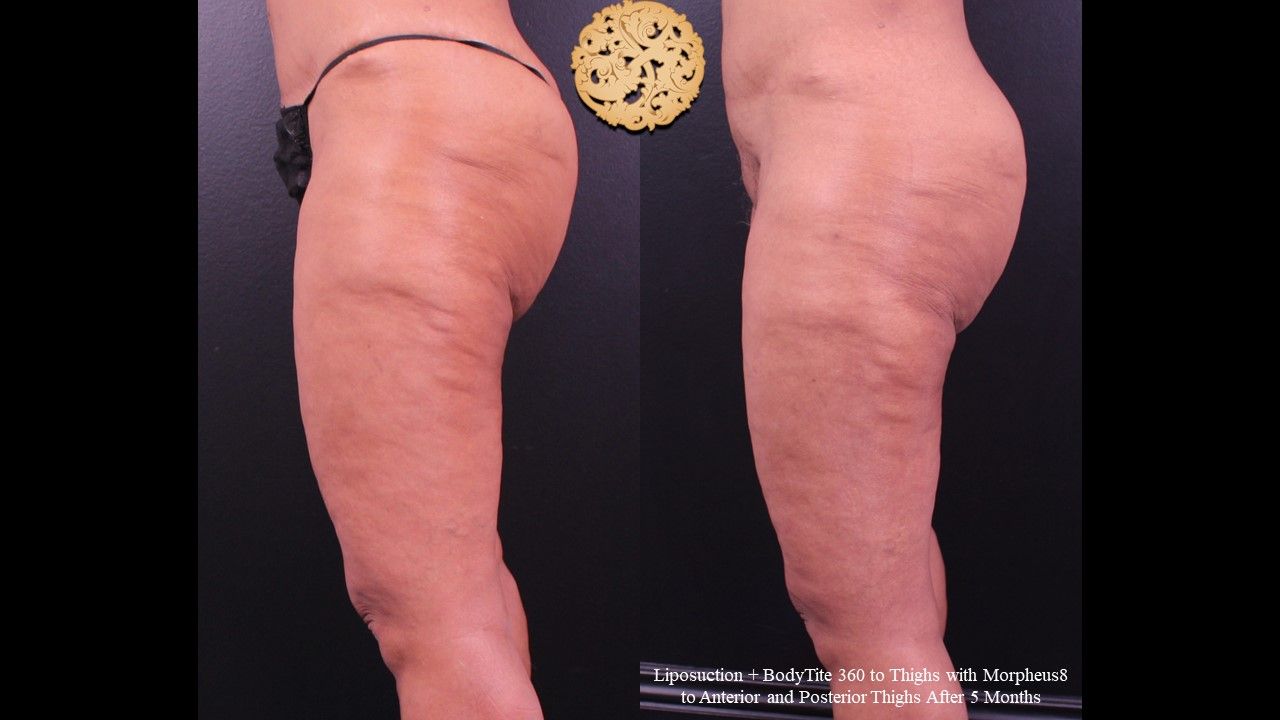 Liposuction Legs Before & After