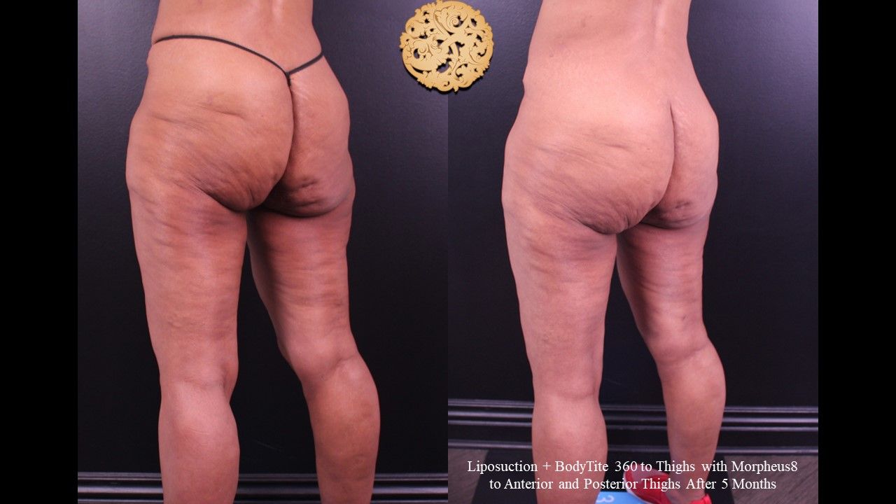 Liposuction Legs Before & After
