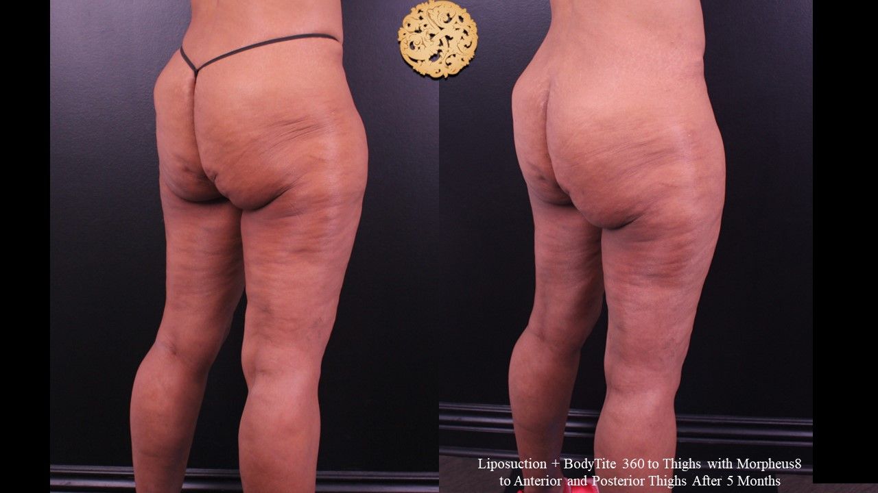 Liposuction Legs Before & After
