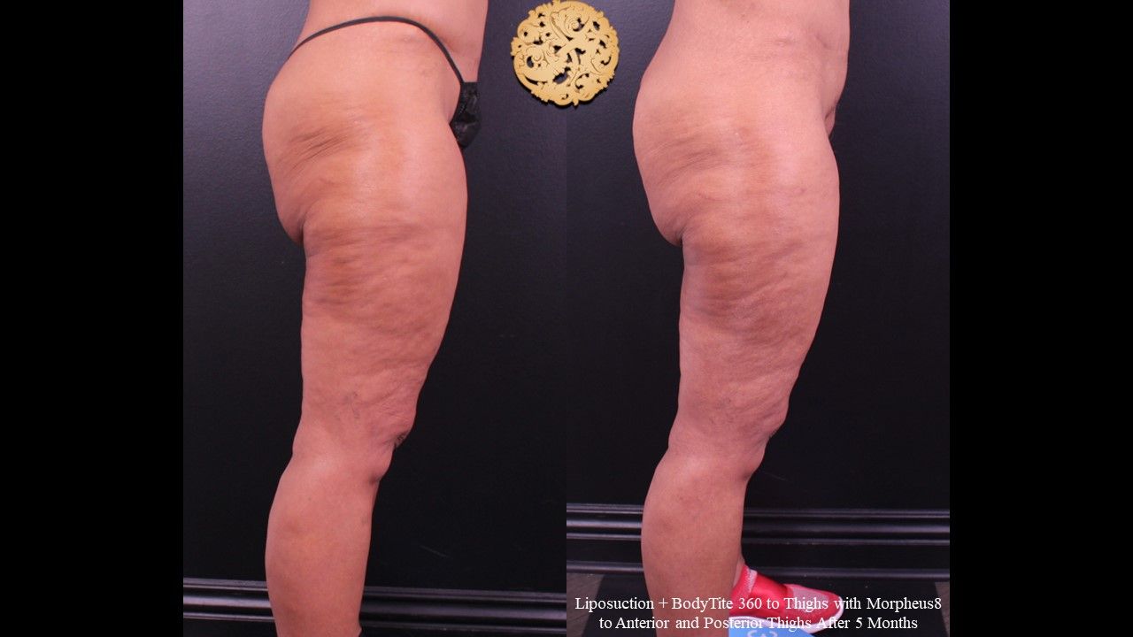 Liposuction Legs Before & After