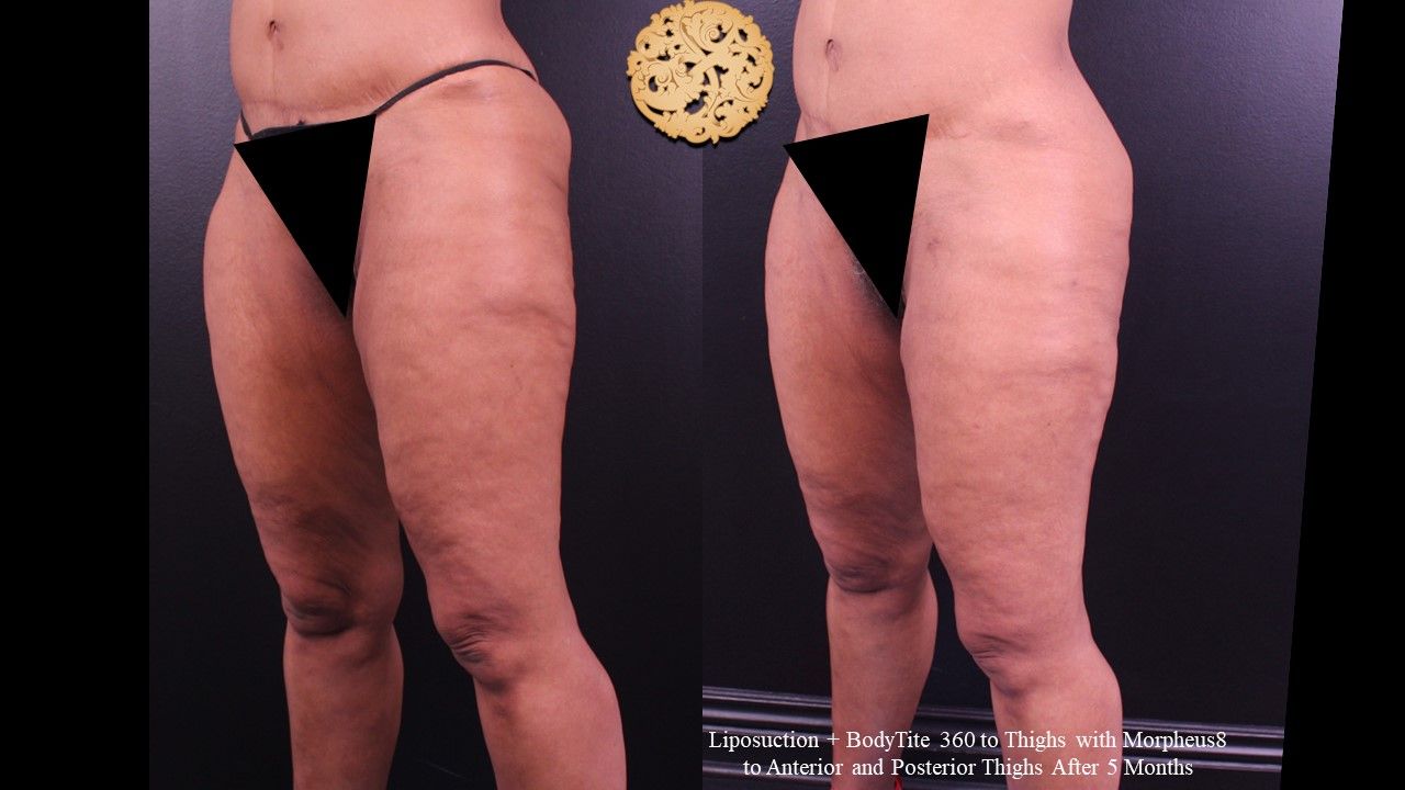 Liposuction Legs Before & After