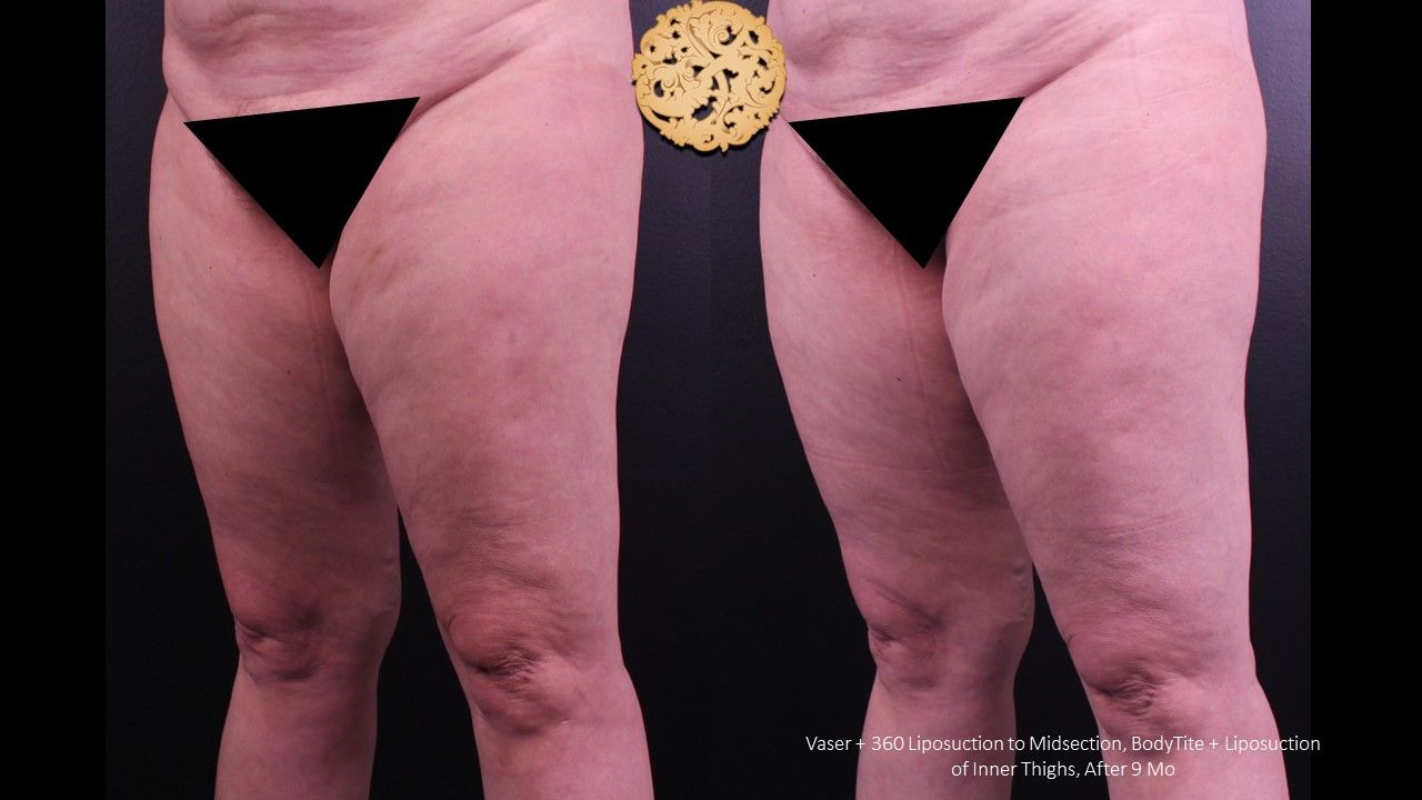 Liposuction Legs Before & After