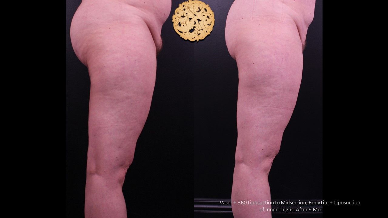 Liposuction Legs Before & After