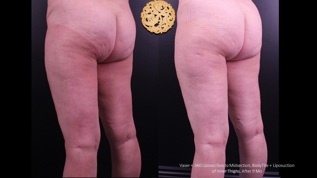 Liposuction Legs Before & After