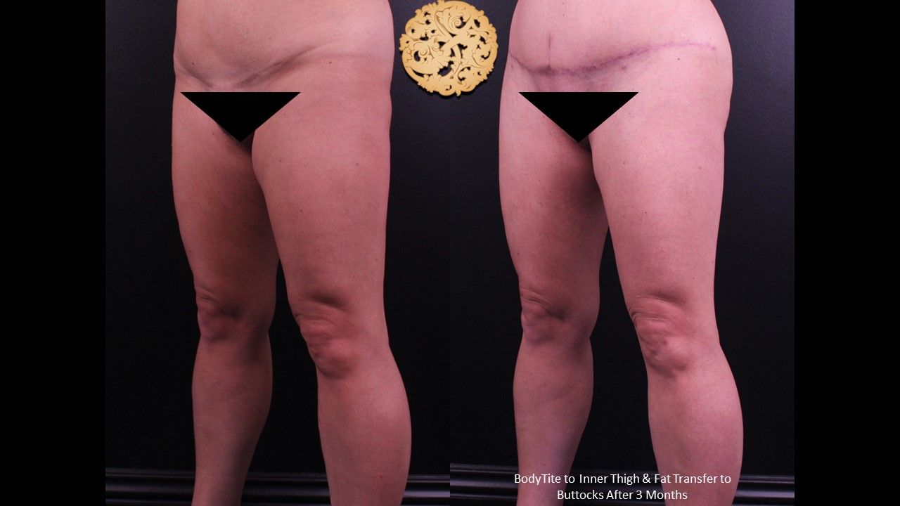 Liposuction Legs Before & After
