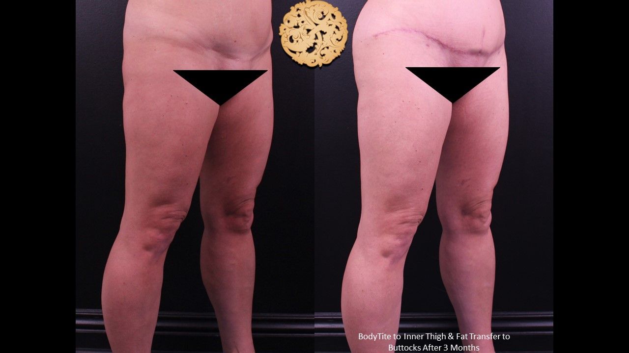 Liposuction Legs Before & After
