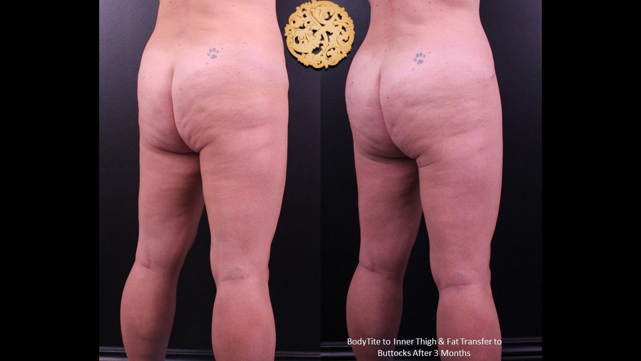 Liposuction Legs Before & After