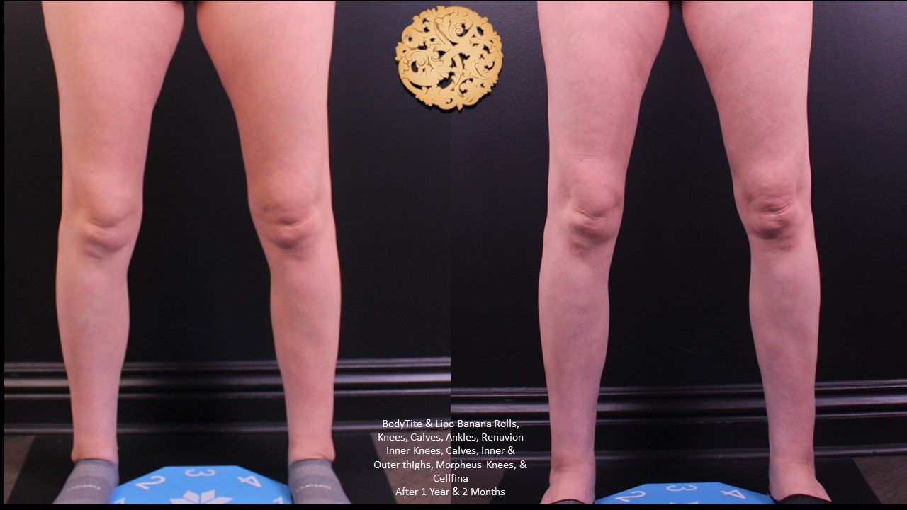 Liposuction Legs Before & After