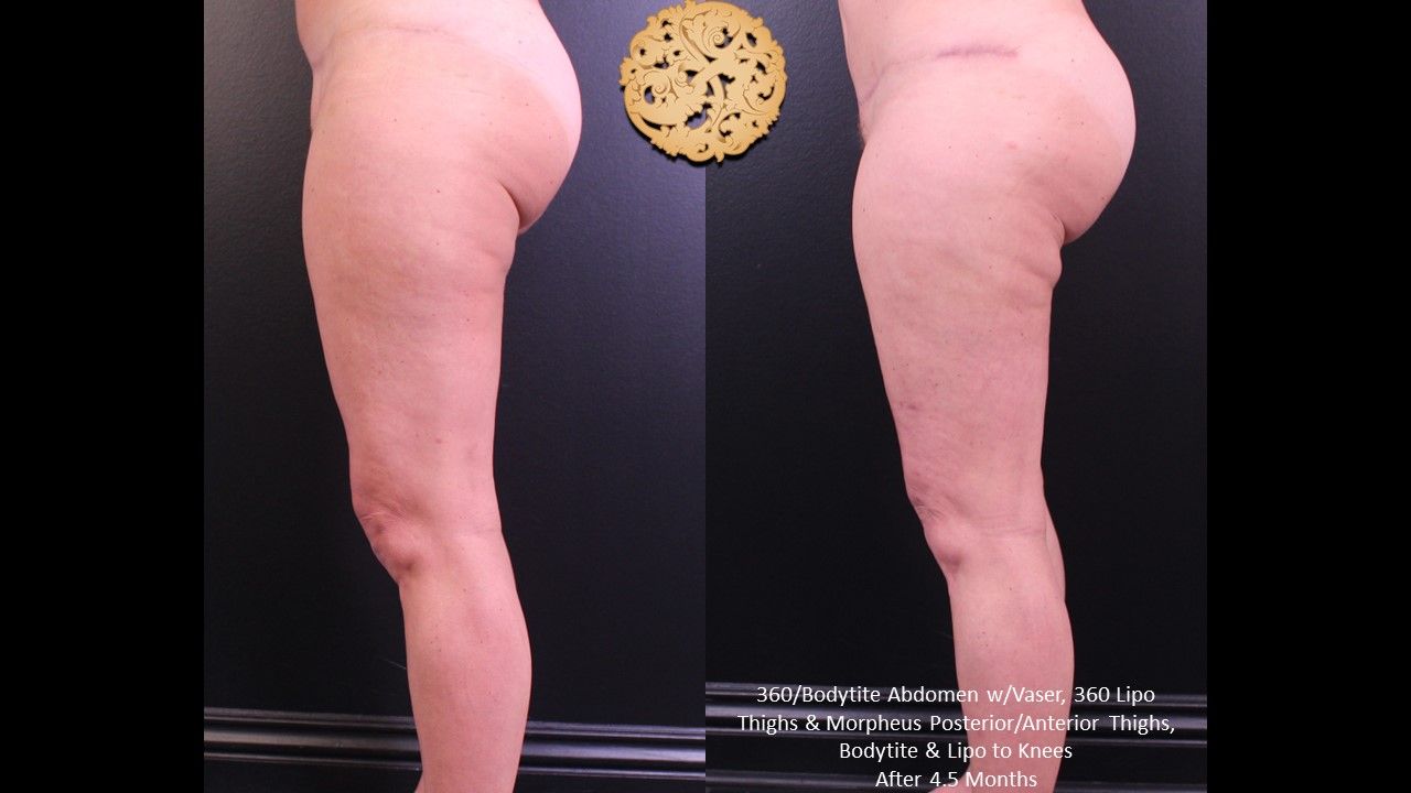 Liposuction Legs Before & After