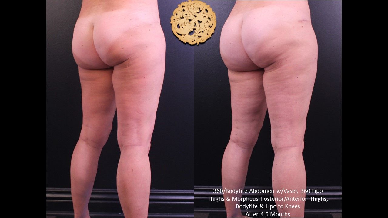 Liposuction Legs Before & After