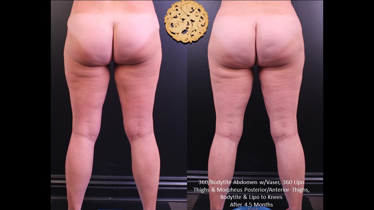 Liposuction Legs Before & After