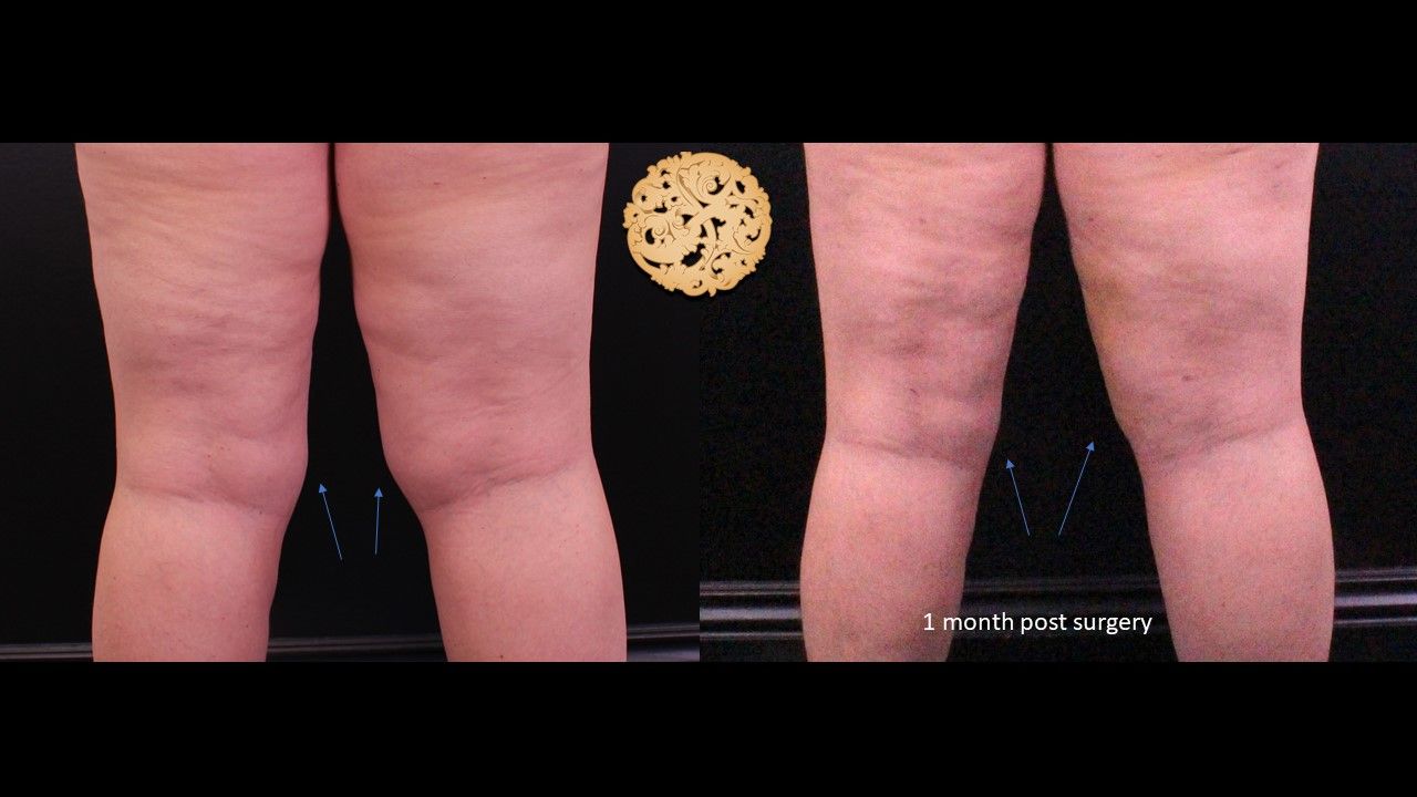 Liposuction Legs Before & After