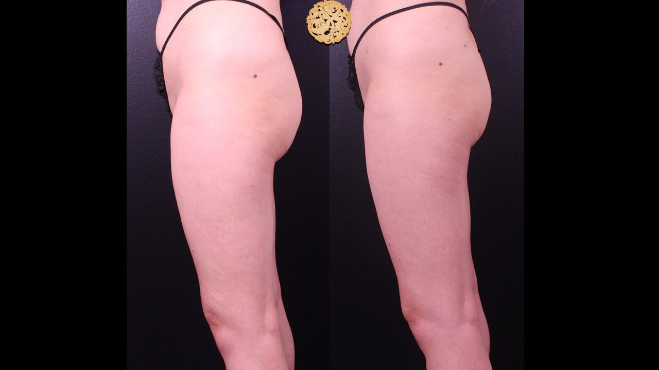 Liposuction Legs Before & After