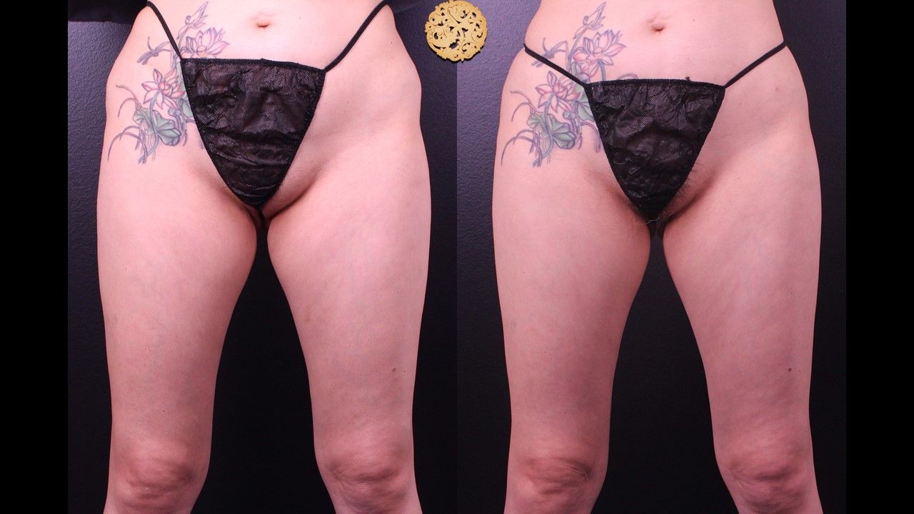 Liposuction Legs Before & After
