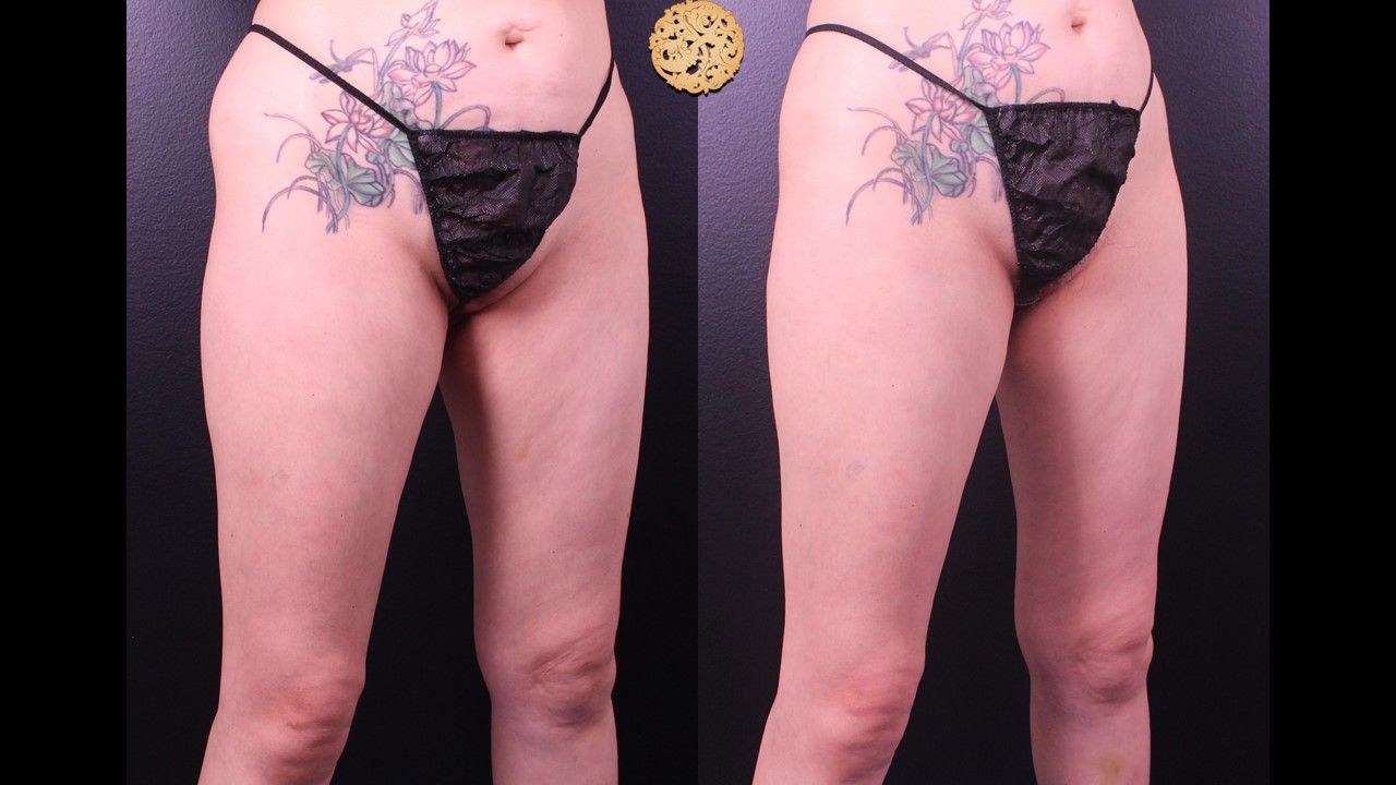 Liposuction Legs Before & After