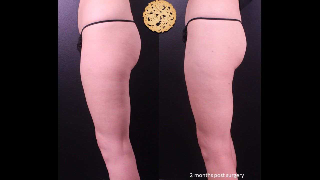 Liposuction Legs Before & After