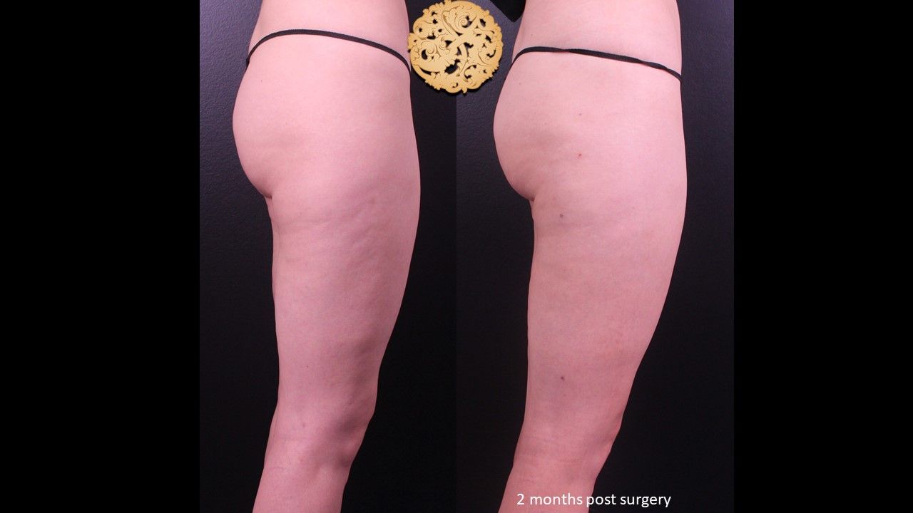 Liposuction Legs Before & After