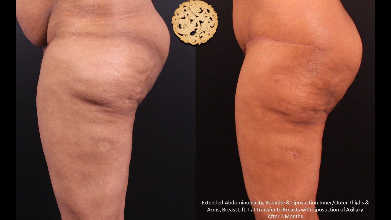 Liposuction Legs Before & After