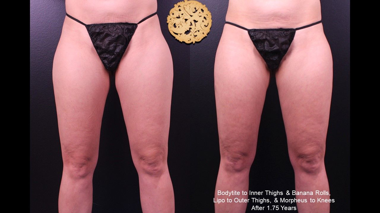 Liposuction Legs Before & After