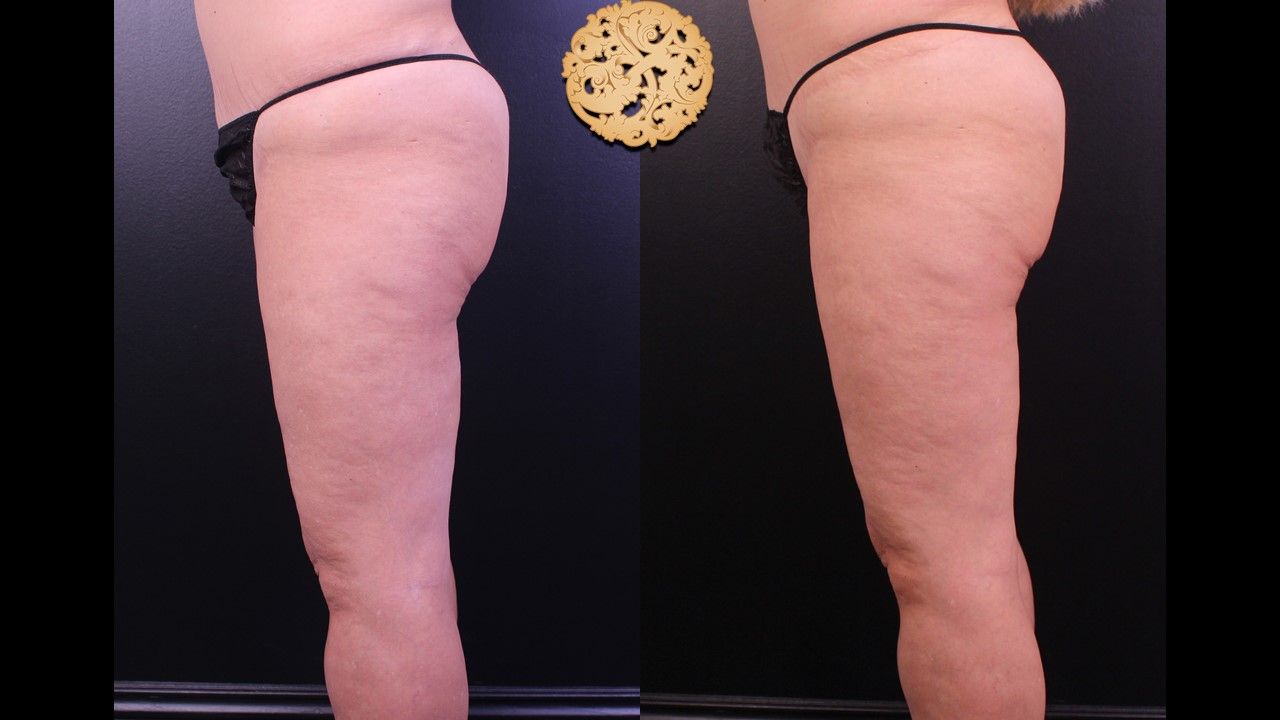 Liposuction Legs Before & After