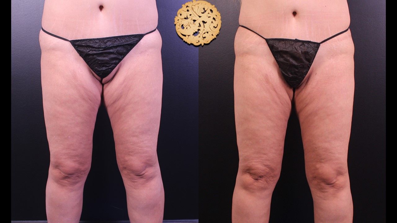 Liposuction Legs Before & After