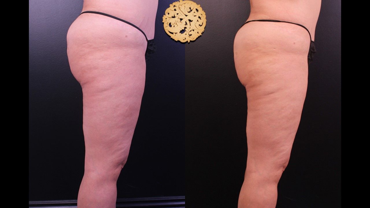 Liposuction Legs Before & After