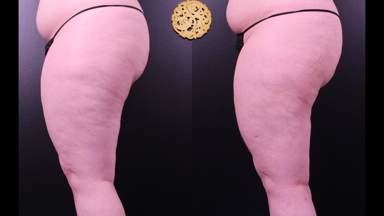 Liposuction Legs Before & After
