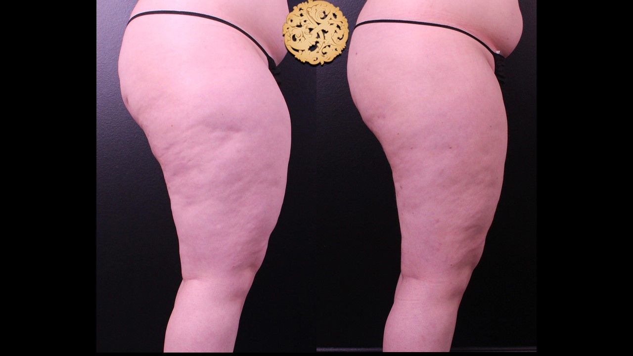 Liposuction Legs Before & After