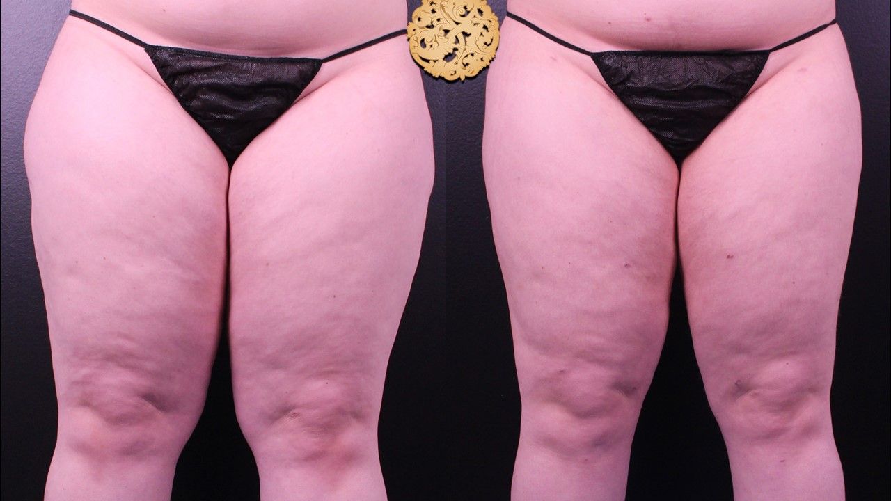 Liposuction Legs Before & After