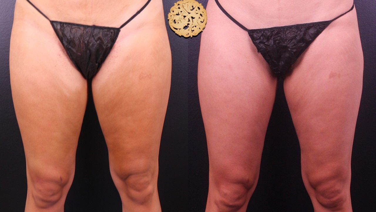 Liposuction Legs Before & After