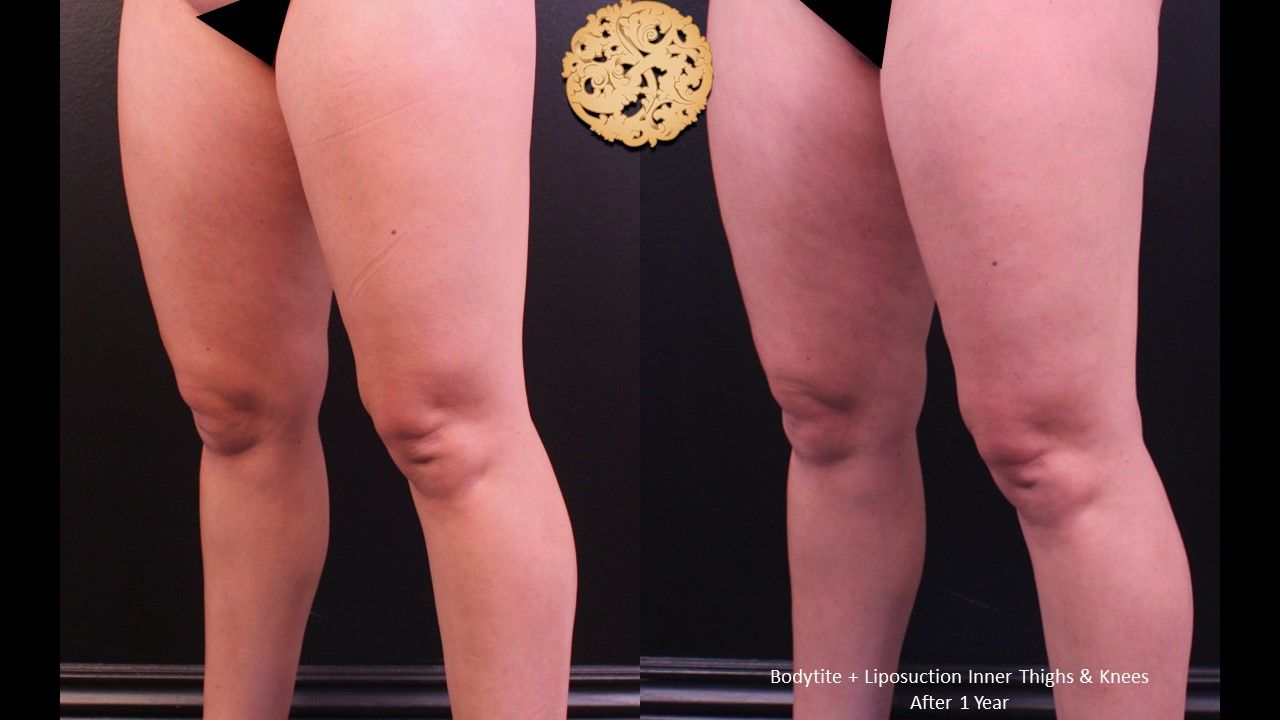 Liposuction Legs Before & After
