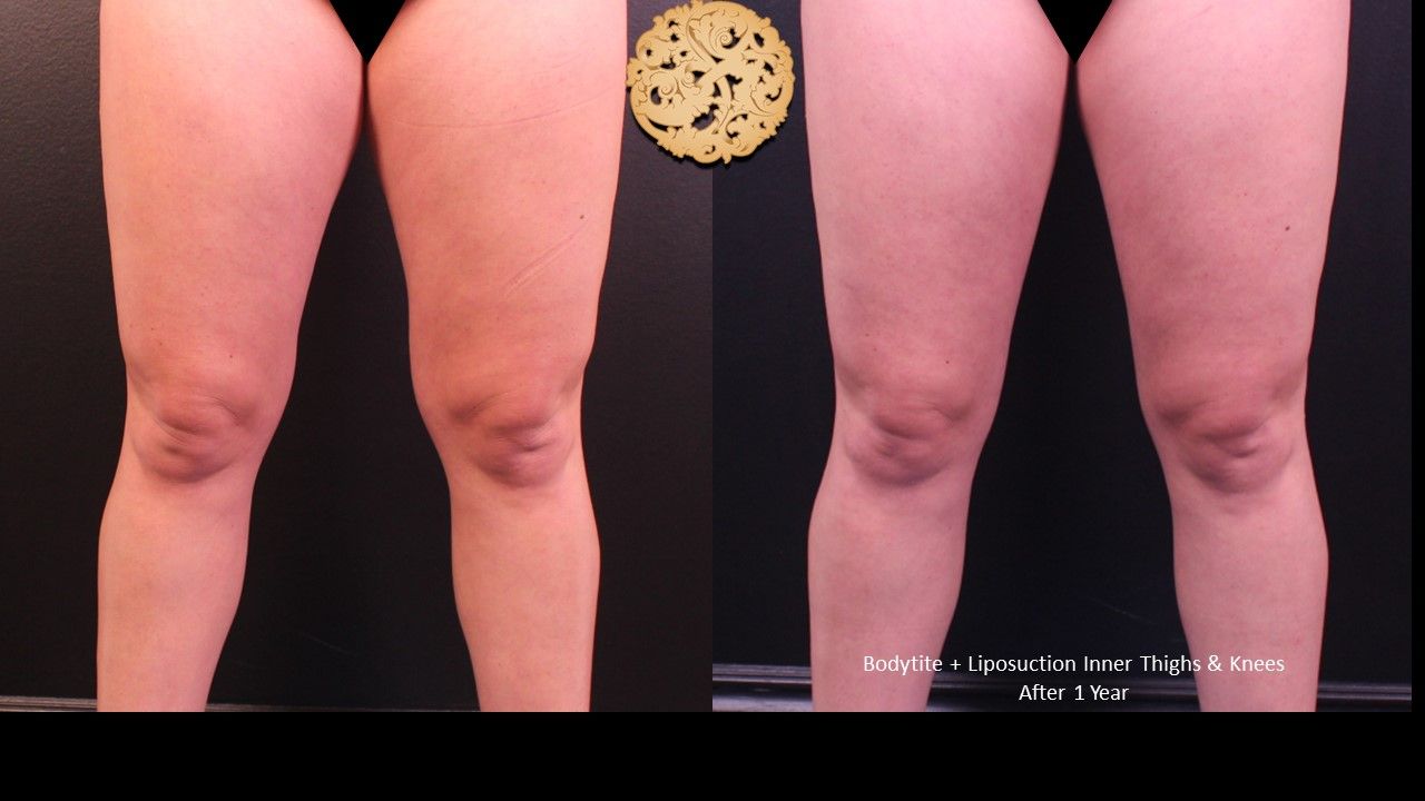 Liposuction Legs Before & After