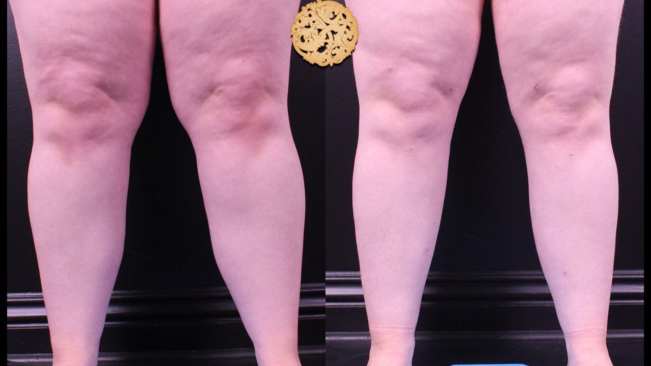 Liposuction Legs Before & After