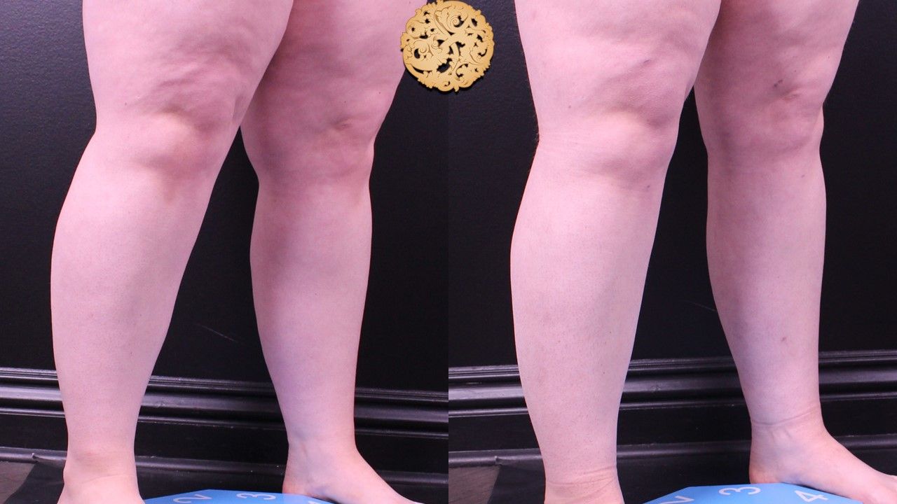 Liposuction Legs Before & After