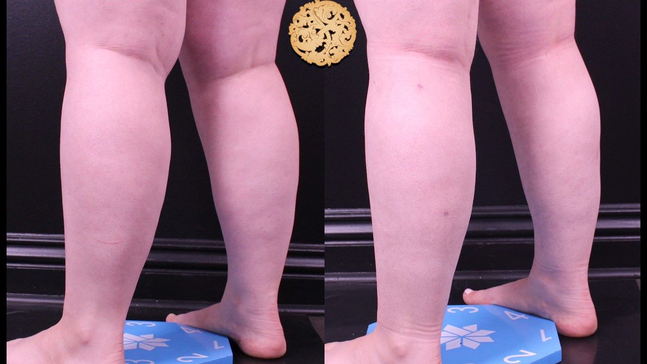 Liposuction Legs Before & After