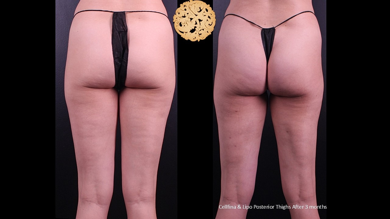 Lipo Posterior thighs & Cellfina After 3 months 