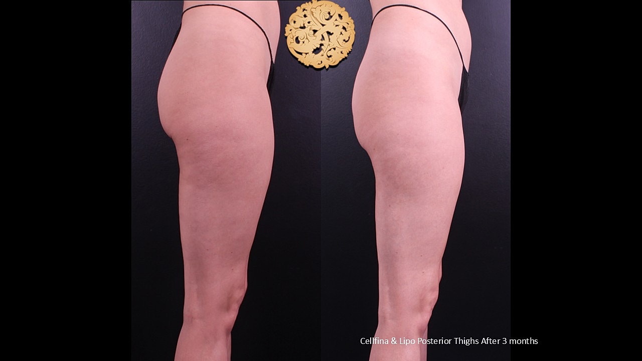 Lipo Posterior thighs & Cellfina After 3 months 