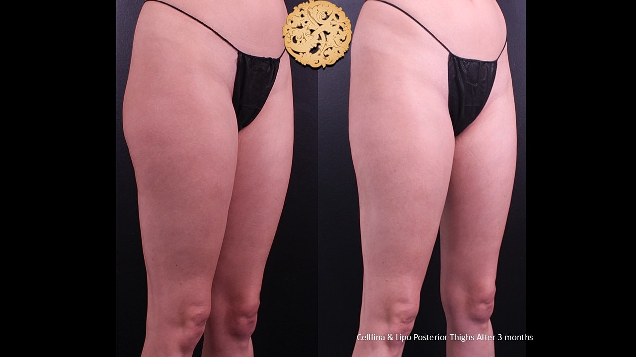Lipo Posterior thighs & Cellfina After 3 months 