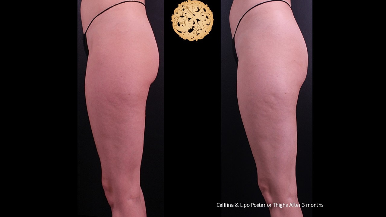 Lipo Posterior thighs & Cellfina After 3 months 
