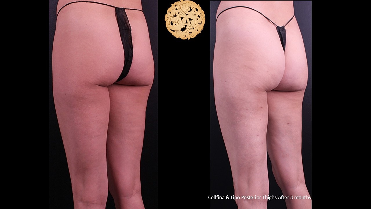 Lipo Posterior thighs & Cellfina After 3 months 