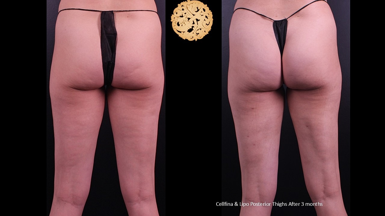 Lipo Posterior thighs & Cellfina After 3 months 