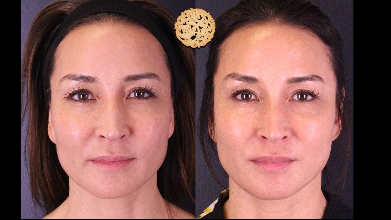 Dermapen Microneedling Before & After