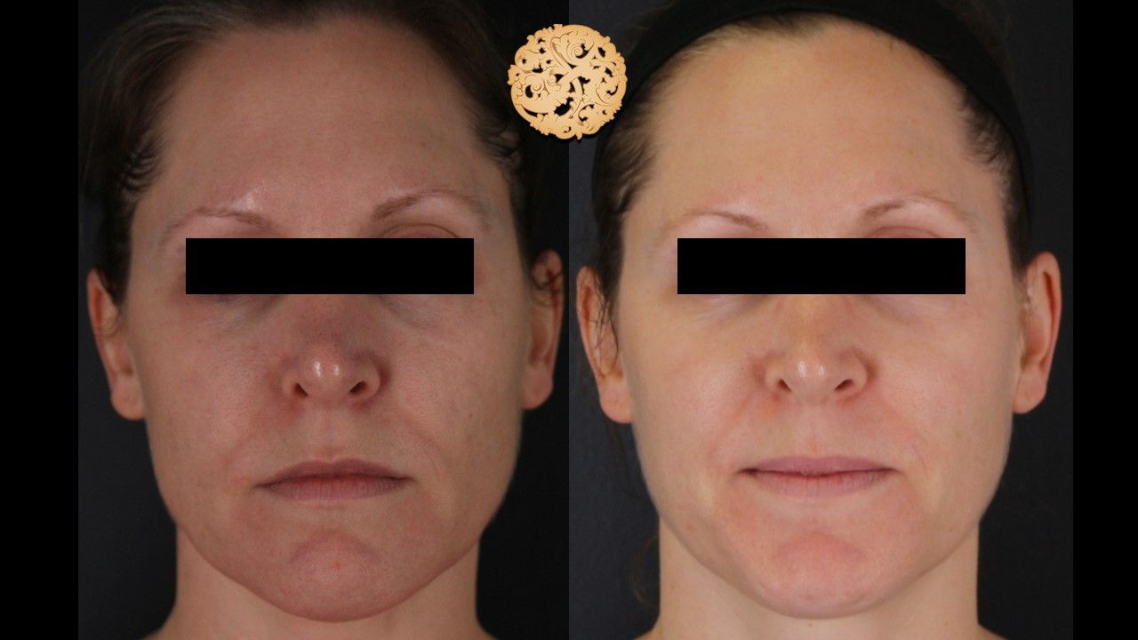 Dermapen Microneedling Before & After