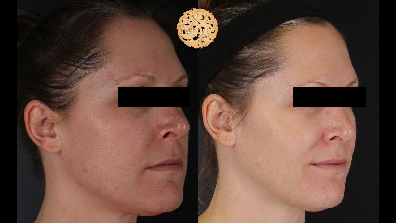 Dermapen Microneedling Before & After