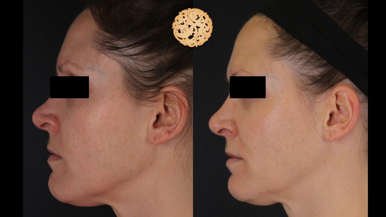 Dermapen Microneedling Before & After