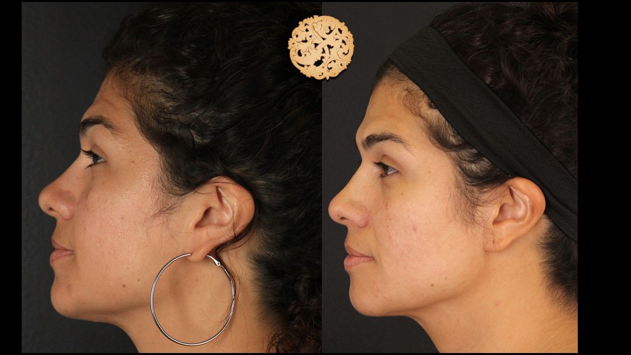 Dermapen Microneedling Before & After