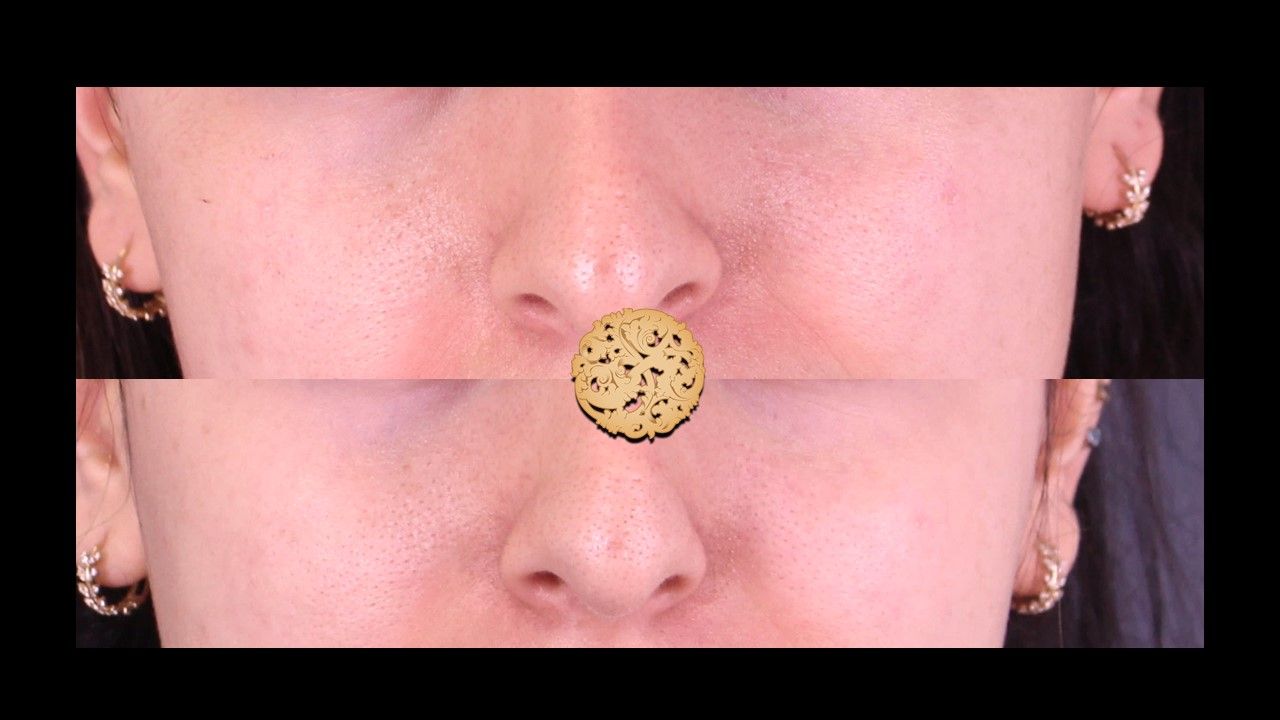 Dermapen Microneedling Before & After