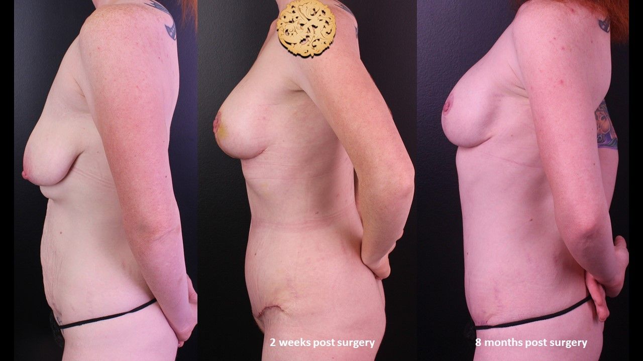 Mommy Makeover Before & After