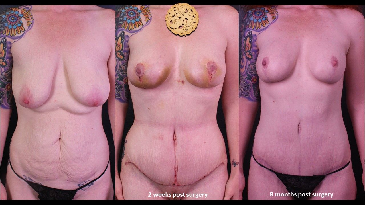 Mommy Makeover Before & After