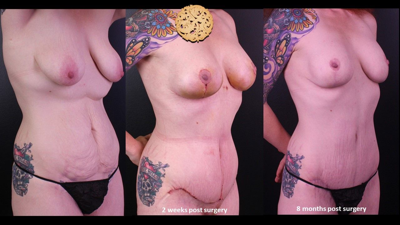 Mommy Makeover Before & After